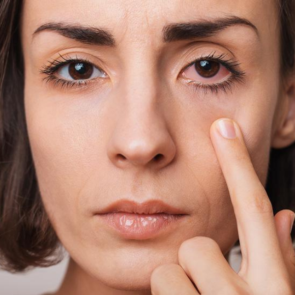 Woman with pinkeye