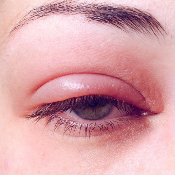 Image of an enflamed eyelid